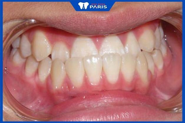 Thời gian chỉnh nha khớp cắn ngược phụ thuộc vào mức độ sai lệch của răng
