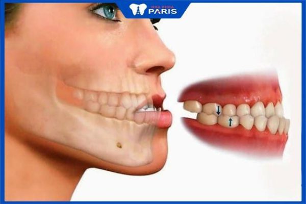Niềng răng khớp cắn ngược bao lâu – 4 yếu tố ảnh hưởng