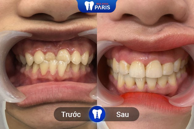 Tình trạng răng khấp khểnh được cải thiện sau niềng