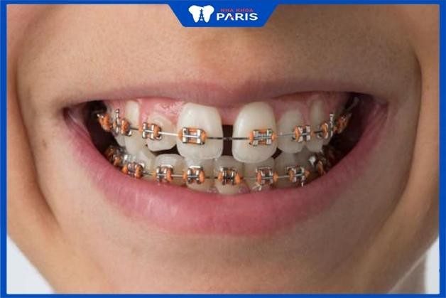 Thời gian niềng răng thưa thường dao động trong khoảng 18 - 24 tháng