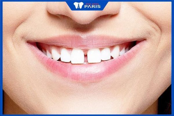 Niềng răng thưa có đau không – Mẹo giúp giảm đau bạn nên biết
