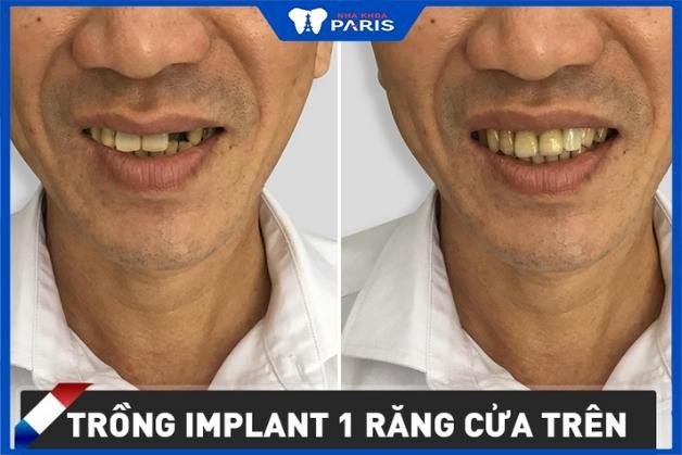Hình ảnh khách hàng sau cấy ghép răng Implant