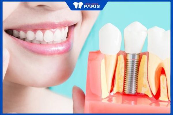 Trồng răng Implant được bao lâu, 4 yếu tố ảnh hưởng trực tiếp