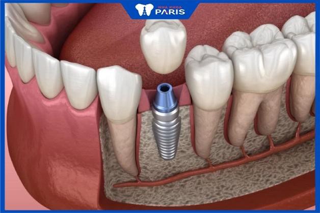 Trồng răng Implant được bao lâu, có vĩnh viễn không