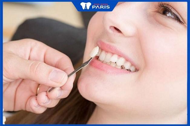 Đắp răng khểnh là phương pháp được nhiều người lựa chọn