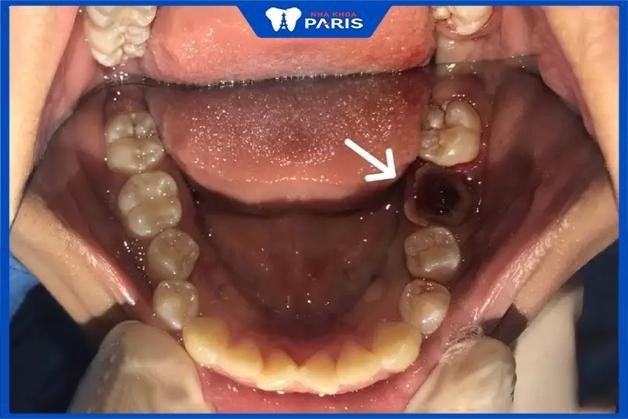 Trường hợp cụ thể nào cần nhổ răng cấm hàm trên