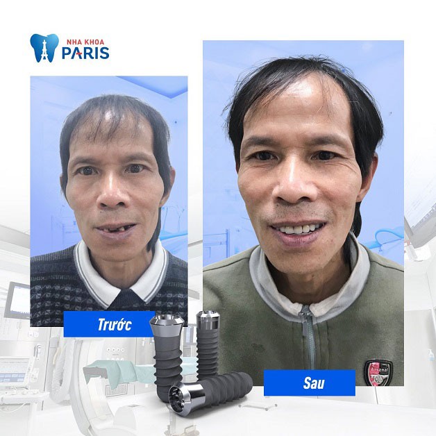 Mọi khách hàng đầu hài lòng với dịch vụ implant tại nha khoa Paris