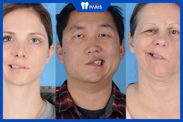 Lệch mặt do các bệnh lý dẫn đến liệt