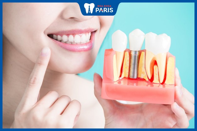 Bí quyết chăm sóc răng miệng sau khi trồng răng Implant