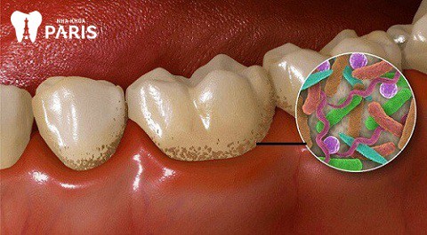 Lấy cao răng có hết hôi miệng không: giải pháp hiệu quả cho hôi miệng