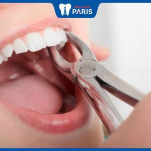 Nhổ răng có đau không? Trải nghiệm nhổ răng của cô gái 28 tuổi