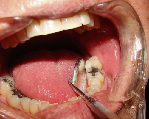 Nên nhổ răng hàm dưới khi nào? Có nguy hiểm không?