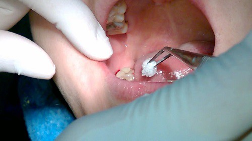 Nhổ răng số 6 có nguy hiểm không? Tư vấn từ chuyên gia