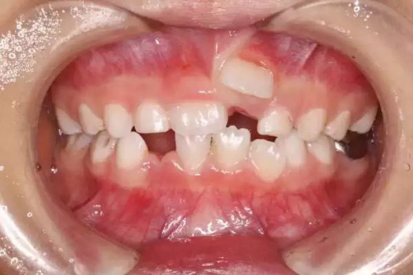 Nhổ răng thừa có tốt không? – Lời khuyên từ chuyên gia