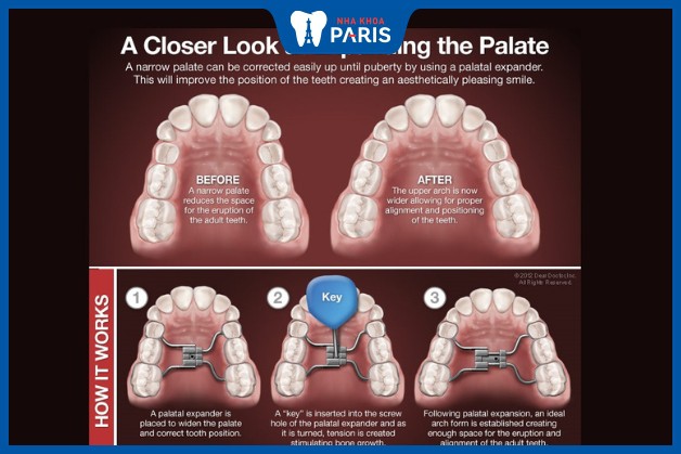 Nong hàm là biện pháp cơi nới rộng diện tích hàm răng