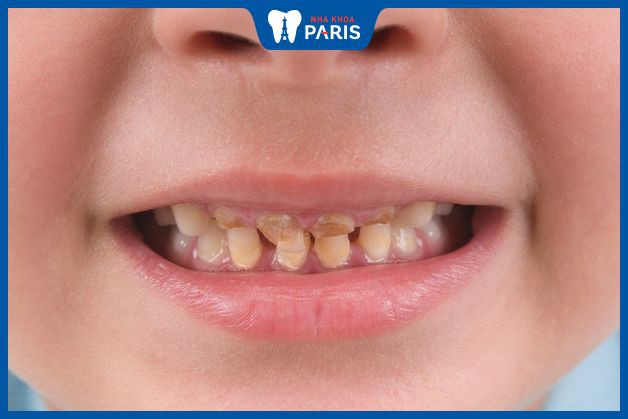 Răng ố vàng ảnh hưởng nhiều đến sinh hoạt của trẻ
