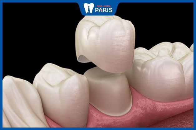 17 tuổi có thể bọc răng sứ khi răng vĩnh viễn và xương hàm đã phát triển ổn định