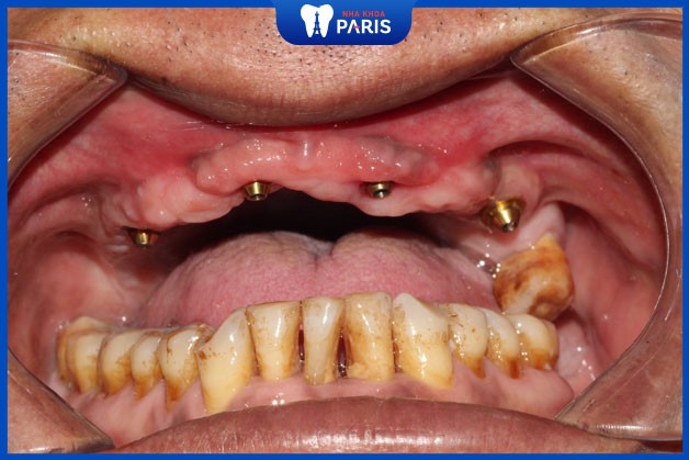 Mỗi người có tình trạng răng khác nhau dẫn đến chi phí khác nhau