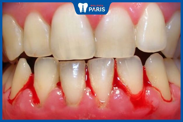 Chảy máu chân răng có thể do bệnh lý răng miệng