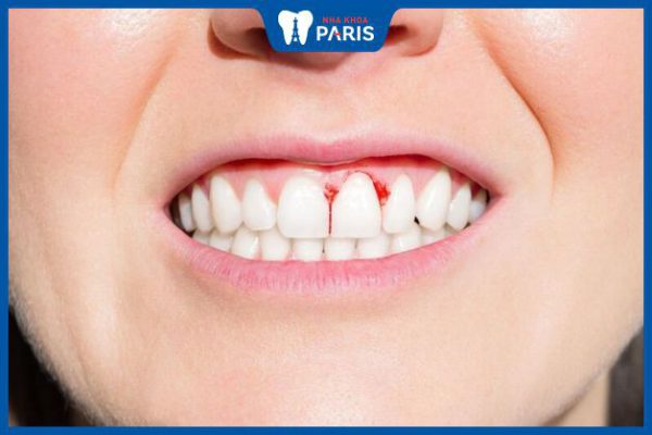 Bọc răng sứ bị viêm lợi: Nguyên nhân, dấu hiệu và cách điều trị