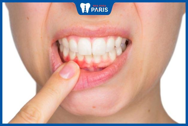 Bọc răng sứ bị viêm lợi có nguy hiểm gì không?