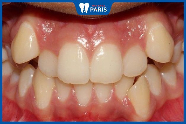 Trường hợp răng bị sai lệch nghiêm trọng không thể áp dụng kỹ thuật dán răng sứ