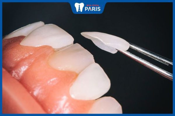 Bọc răng sứ siêu mỏng có tốt không – Trường hợp nên áp dụng