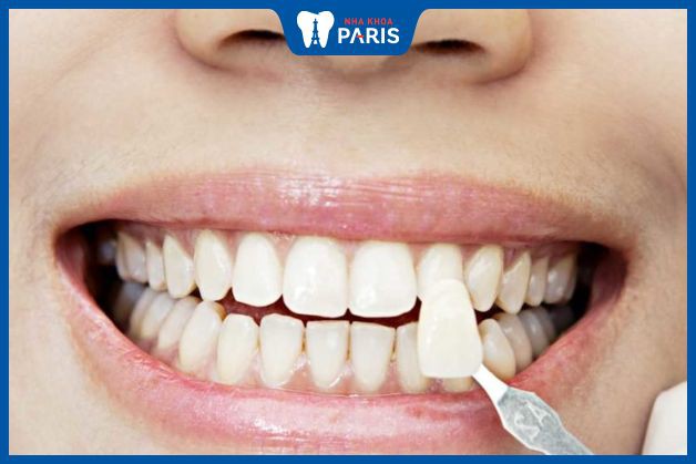 Cách chăm sóc răng miệng sau khi thực hiện bọc sứ