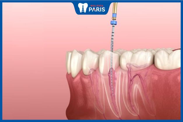 Cách chữa viêm tủy răng triệt để tại phòng khám nha khoa