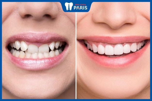 Tại sao phải bọc răng sứ - Cải thiện khuyết điểm của răng