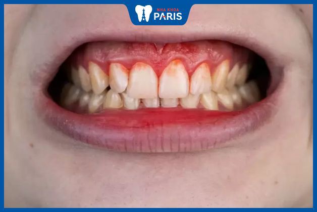 Nếu chảy máu chân răng không được xử lý kịp thời có thể gây ảnh hưởng tới sức khỏe