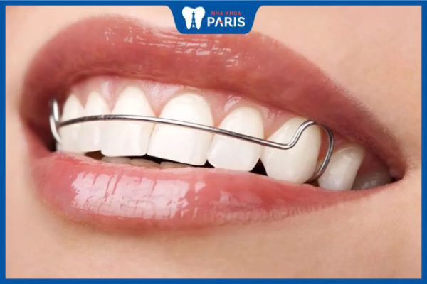 Ê răng khi đeo hàm duy trì do đâu – Biện pháp khắc phục