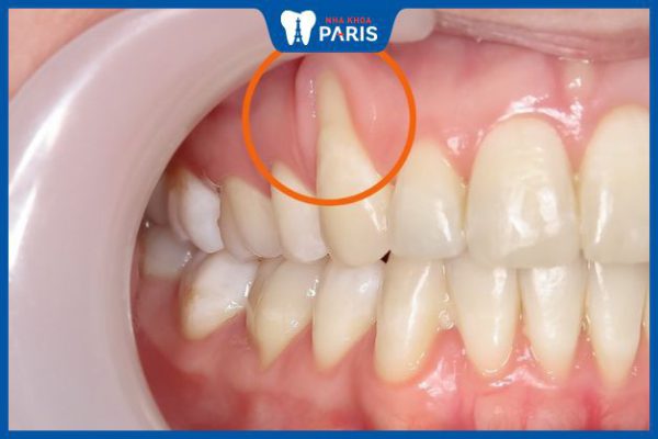 Hiện tượng tụt nướu răng: Nguyên nhân, triệu chứng và cách điều trị