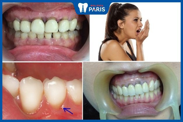 Một số biến chứng sau khi bọc răng sứ có thể gặp