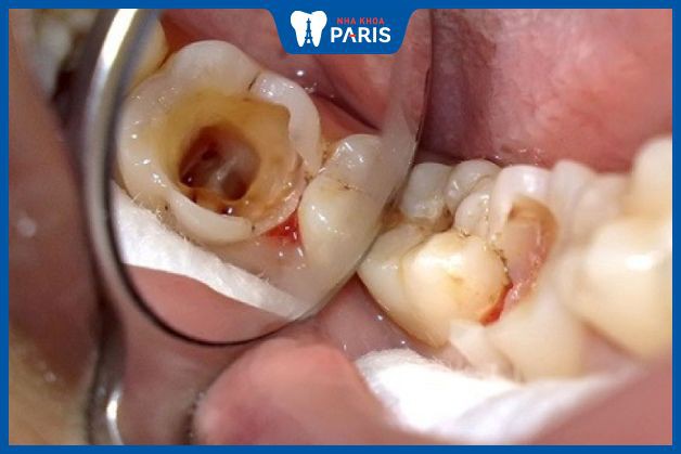 Răng bị lộ tủy là dấu hiệu nhận biết viêm tủy răng