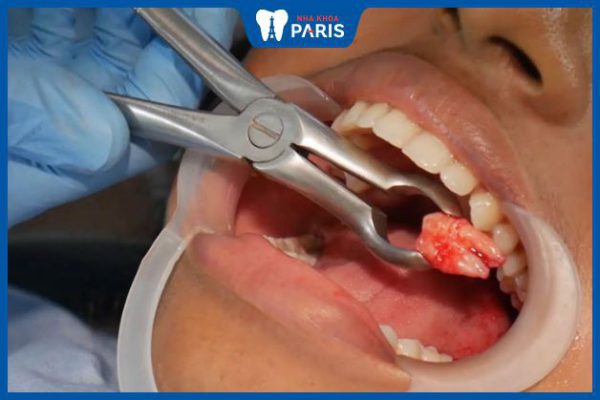 Nhổ răng cấm có bị chảy máu không? Cách vệ sinh sau khi nhổ