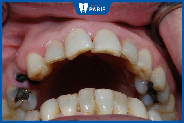 Giá nhổ răng sâu hàm trên vào khoảng 100.000 - 5.000.000 đồng/răng