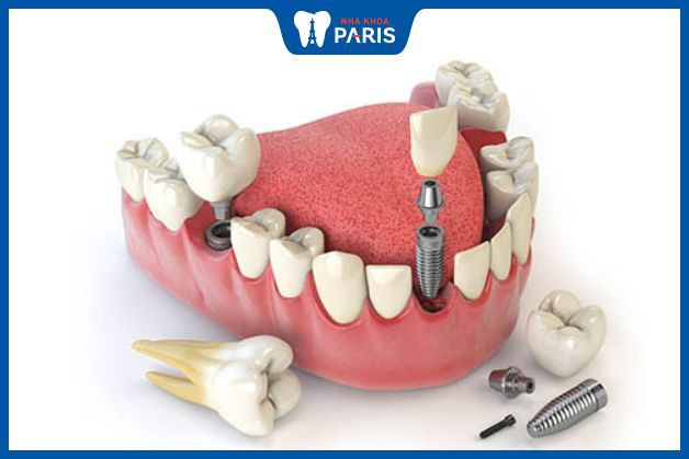 Chi phí cấy ghép implant phụ thuộc vào tình trạng răng và giá trị trụ cùng mão sứ