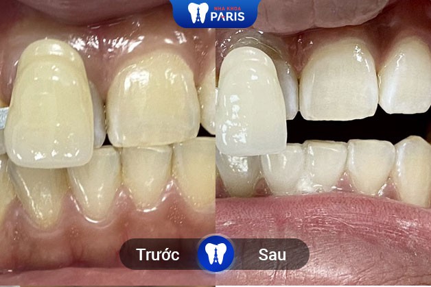 Tình trạng răng ố vàng đã được cải thiện ngay sau khi tẩy trắng răng WhiteMax
