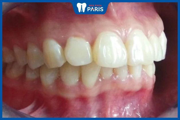 Đa số các trường hợp răng hô do di truyền là gen trội - răng hô là gen trội hay lặn