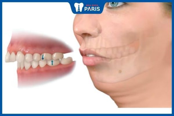 Răng hô là gen trội hay lặn – 3 phương pháp khắc phục răng hô