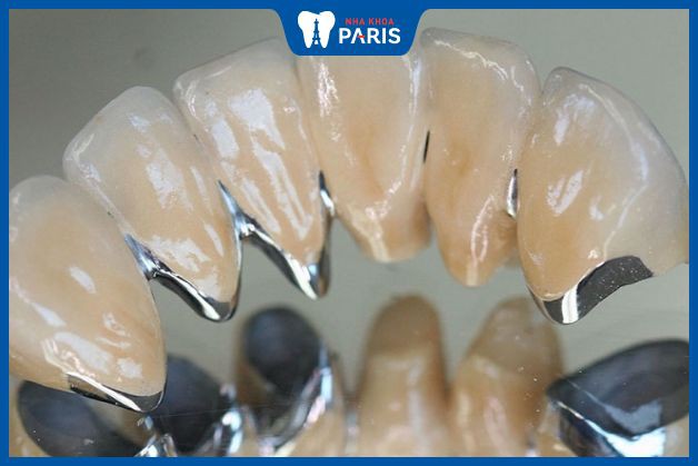 Răng sứ titan có thể giảm giá sâu vào những dịp khuyến mại