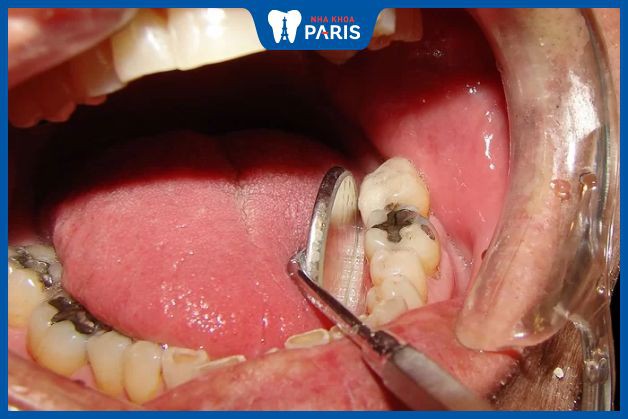 1. Sâu răng được hình thành thế nào