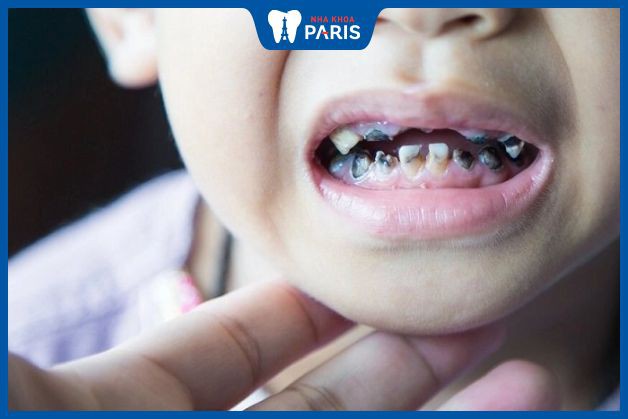 Tại sao trẻ dễ bị sâu răng