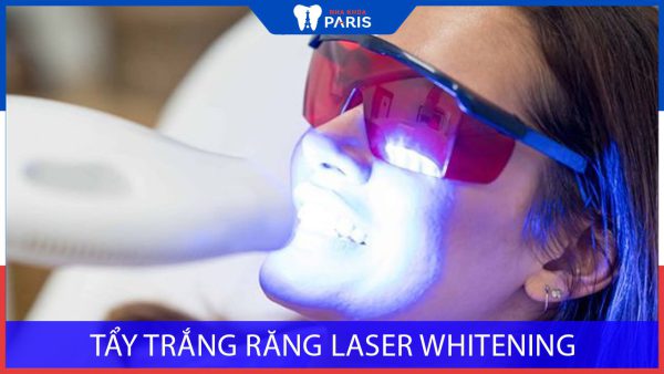 Tẩy trắng răng Laser Whitening: Ưu điểm, quy trình và chi phí