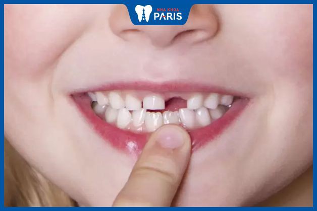 Trẻ bắt đầu thay răng từ 6 tuổi