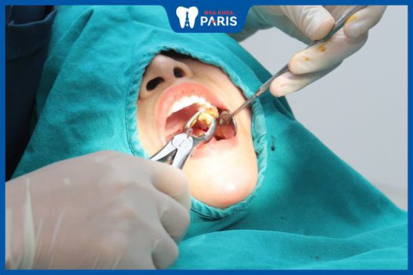 7 biến chứng nhổ răng khôn hàm dưới có thể xảy ra