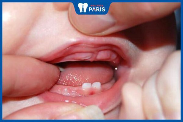 Bé bị hôi miệng khi mọc răng do đâu – Biện pháp xử lý hiệu quả