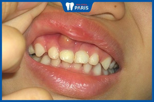 Bệnh viêm nướu răng ở trẻ em : Nguyên nhân và cách điều trị