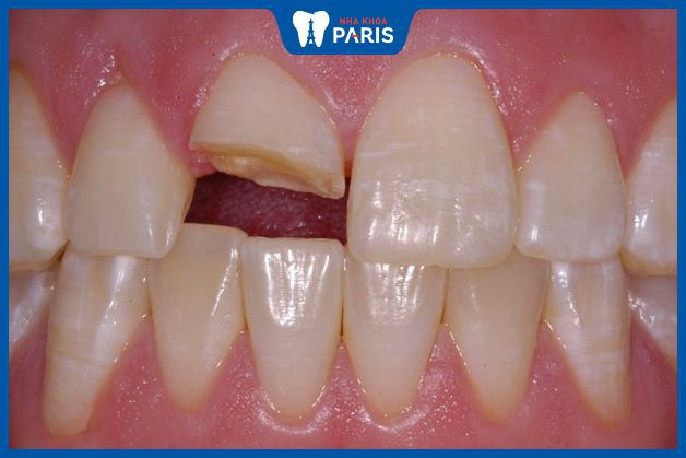 Răng bị vỡ có thể gây viêm tủy